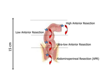 15
cm
High Anterior Resection
Low Anterior Resection
Ultra-low Anterior Resection
Abdominoperineal Resection (APR)
 