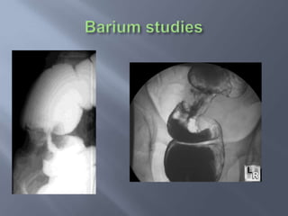 Clinical features Descending & Sigmoid colon 34%     - Changing bowel habits / stool caliber ,         mucous & blood in stools ,adbominal pain         mass obstruction / perforation Metastatic disease      - Cachexia , wt loss , jaundice , mass , ascites ,hepatomegaly, bloomer’s shelf , virchow’s nodes