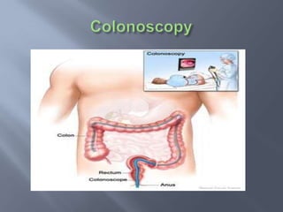 COLON CANCER INVESTIGATIONSClinical ExaminationDouble contrast barium enemaColonoscopy & biopsyC T scan abdomen & pelvisChest x-rayLiver function testCarcinoembryonic AntigenPET & PET-CT         - Role is emerging