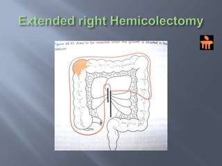 MANAGEMENTSURGERYThe extent of resection is determined by location of primary ,presence / absence of invasion into adjacent structures & distant mets