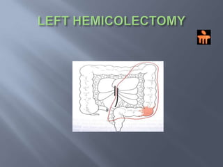 RIGHT HEMICOLECTOMY
