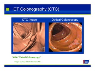 CT Colonography (CTC)
CTC Image Optical Colonoscopy
*AKA “Virtual Colonoscopy”
Images courtesy of Beth McFarland, MD
 