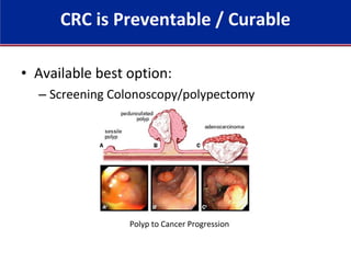 • Available best option:
– Screening Colonoscopy/polypectomy
Polyp to Cancer Progression
CRC is Preventable / Curable
 