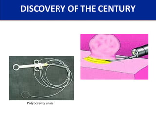 DISCOVERY OF THE CENTURY
Polypectomy snare
 