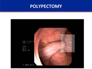 POLYPECTOMY
 