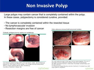 Non Invasive Polyp
Large polyps may contain cancer that is completely contained within the polyp.
In these cases, polypectomy is considered curative, provided:
- The cancer is completely contained within the resected tissue
- No lymphovascular invasion
- Resection margins are free of cancer
 