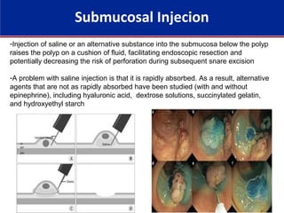 Submucosal Injecion
-Injection of saline or an alternative substance into the submucosa below the polyp
raises the polyp on a cushion of fluid, facilitating endoscopic resection and
potentially decreasing the risk of perforation during subsequent snare excision
-A problem with saline injection is that it is rapidly absorbed. As a result, alternative
agents that are not as rapidly absorbed have been studied (with and without
epinephrine), including hyaluronic acid, dextrose solutions, succinylated gelatin,
and hydroxyethyl starch
 