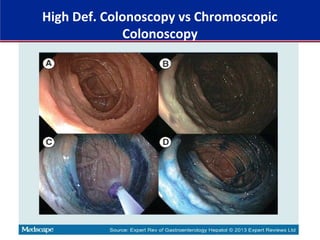 High Def. Colonoscopy vs Chromoscopic
Colonoscopy
 