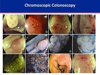 Chromoscopic Colonoscopy
 