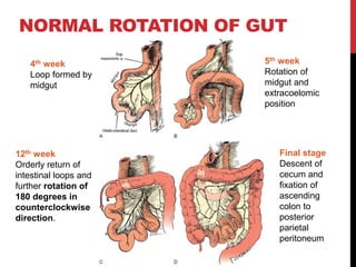 Reverse Rotation Intestine colon cancer full detailed presentation.pptx