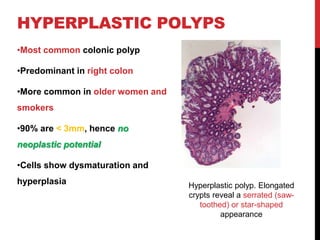 Colonic Crypt Polyp colon cancer full detailed presentation.pptx