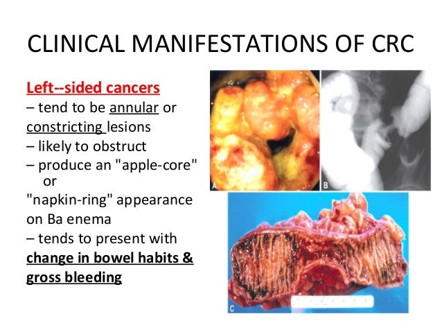 Colon Cancer Lecture