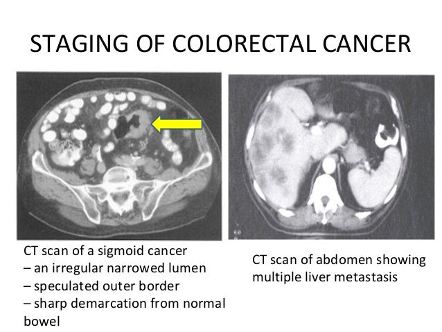 can a ct scan without contrast detect colon cancer