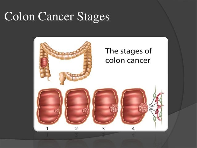 Image Result For Colon Cancer Lymph Nodes Image Result For Colon Cancer Lymph Nodes