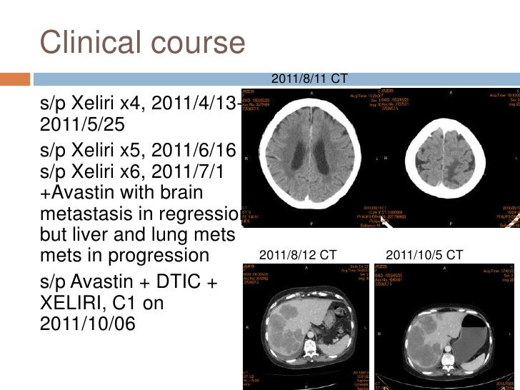 Colon cancer with brain metastasis