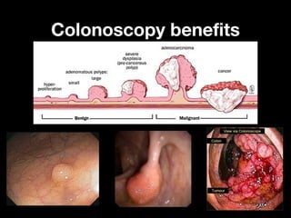 Colonoscopy benefitsColonoscopy benefits
 