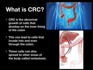 What is CRC?What is CRC?
• CRC is the abnormalCRC is the abnormal
growth of cells thatgrowth of cells that
develop on the inner liningdevelop on the inner lining
of the colonof the colon
• This can lead to cells thatThis can lead to cells that
invade into and eveninvade into and even
through the colon.through the colon.
• These cells can alsoThese cells can also
spread to other areas ofspread to other areas of
the body called metastasis.the body called metastasis.
 