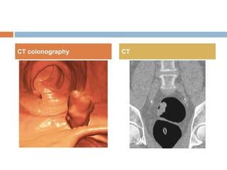 Ct Colon Poly Colonic neoplastic polyps | PPTX