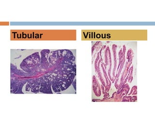 Colonic neoplastic polyps | PPTX