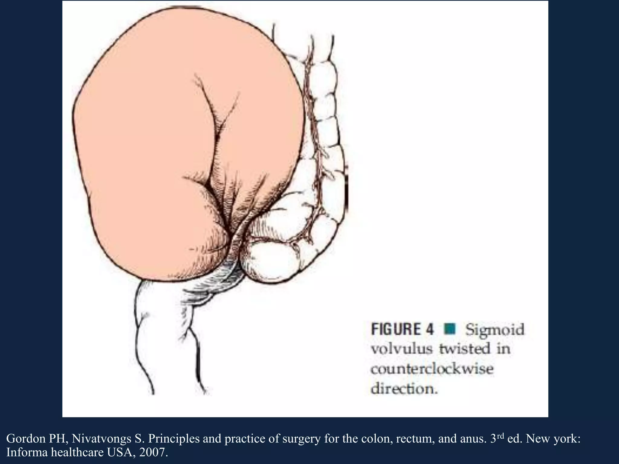 Gordon PH, Nivatvongs S. Principles and practice of surgery for the colon, rectum, and anus. 3rd ed. New york:
Informa healthcare USA, 2007.
 