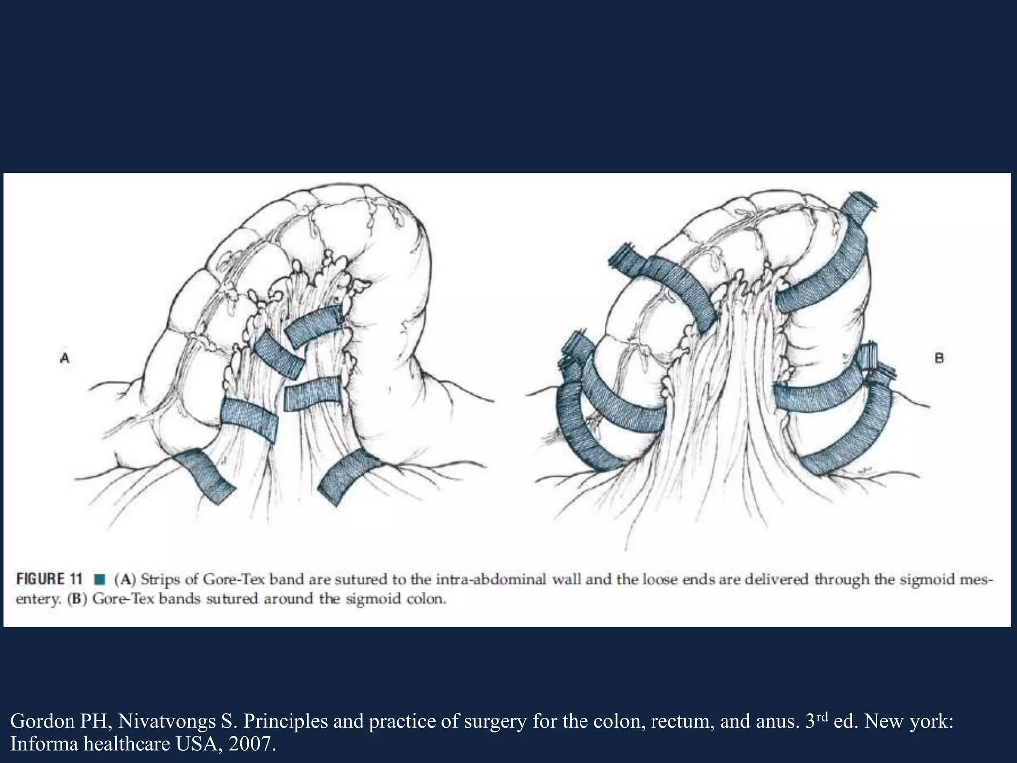 Gordon PH, Nivatvongs S. Principles and practice of surgery for the colon, rectum, and anus. 3rd ed. New york:
Informa healthcare USA, 2007.
 