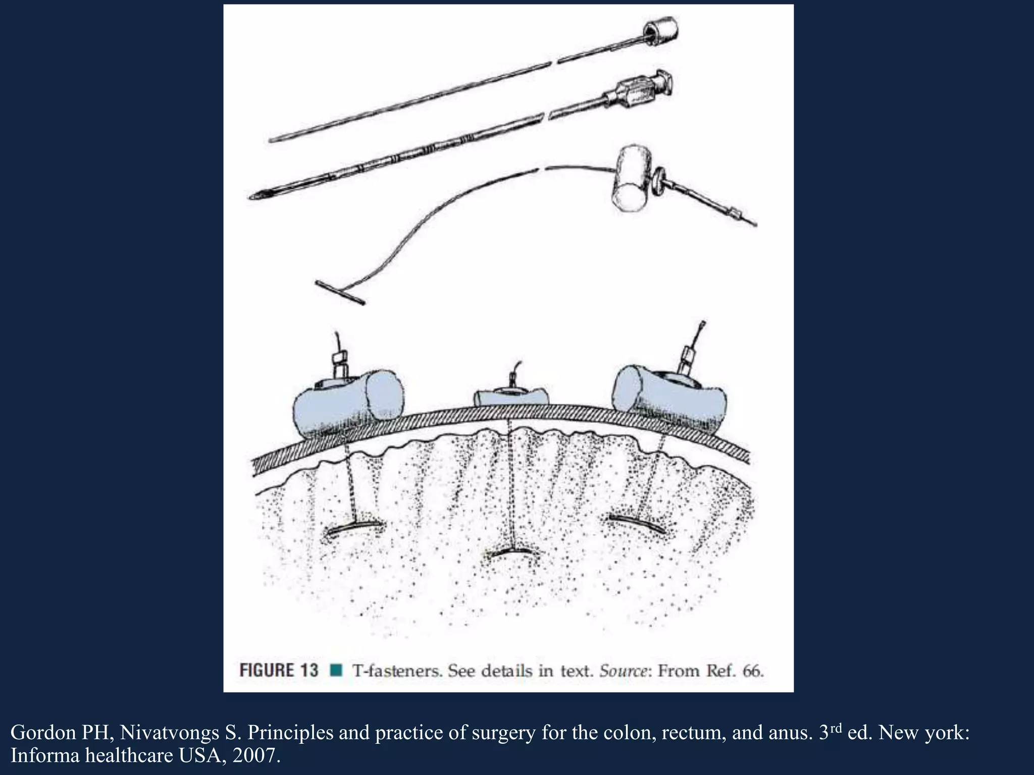 Gordon PH, Nivatvongs S. Principles and practice of surgery for the colon, rectum, and anus. 3rd ed. New york:
Informa healthcare USA, 2007.
 