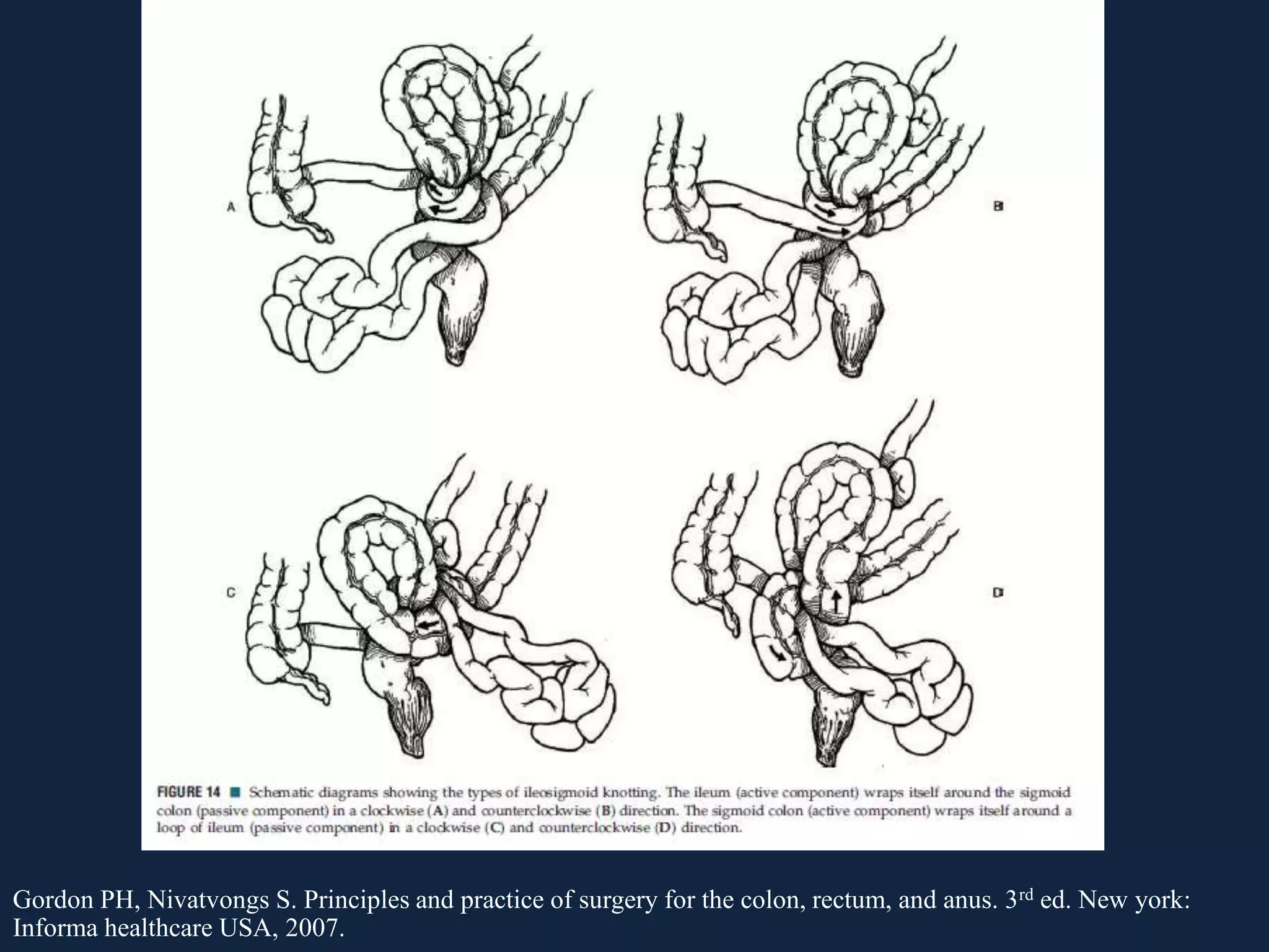 Gordon PH, Nivatvongs S. Principles and practice of surgery for the colon, rectum, and anus. 3rd ed. New york:
Informa healthcare USA, 2007.
 