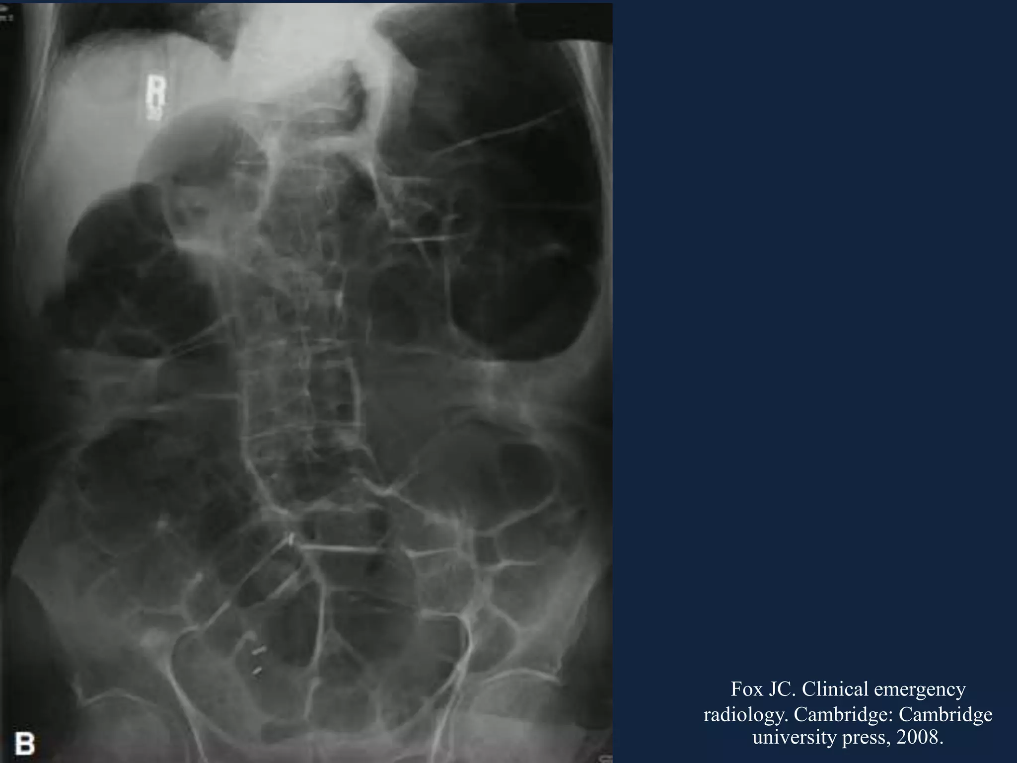 Fox JC. Clinical emergency
radiology. Cambridge: Cambridge
university press, 2008.
 