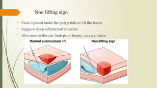 Colonic Polyp.,U.S. Multi-Society Task Force recommendation,2021 ACG ...