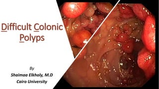 Difficult Colonic
Polyps
By
Shaimaa Elkholy, M.D
Cairo University
 