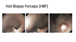Hot Biopsy Forceps (HBF)
 