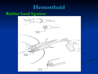 Hemorrhoid <ul><li>Rubber band ligation: </li></ul>