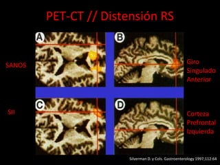 PET-CT // Distensión RS
SANOS
SII
Giro
Singulado
Anterior
Corteza
Prefrontal
Izquierda
Silverman D. y Cols. Gastroenterology 1997;112:64
 