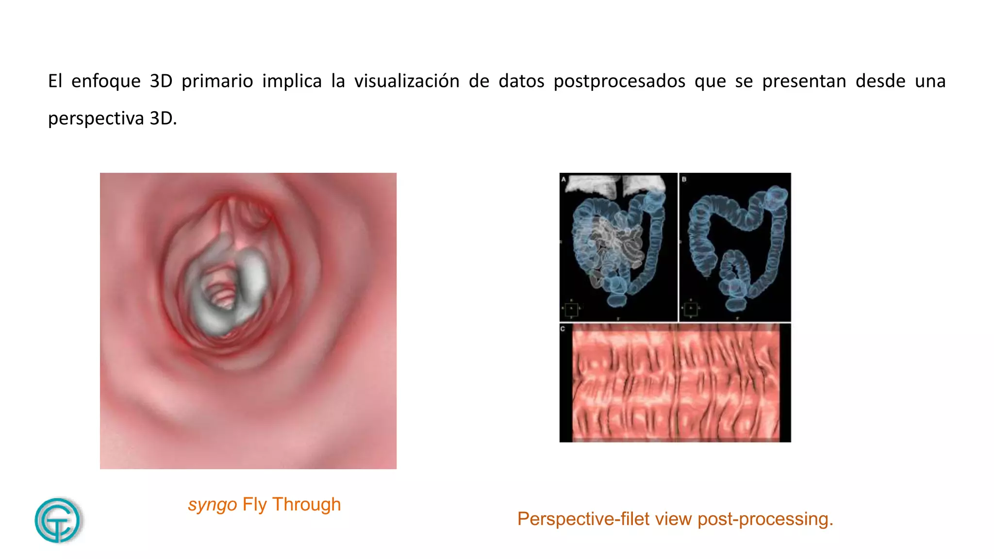 Colonografia por tomografia, colonoscopia virtual | PPTX