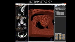 Colonoscopia virtual | PPT