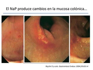 El NaP produce cambios en la mucosa colónica…Rejchrt S y cols. GastrointestEndosc 2004;59:651-4