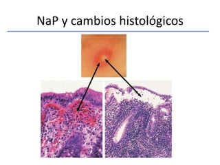 NaP y cambios histológicos