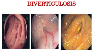 DIVERTICULOSIS
 