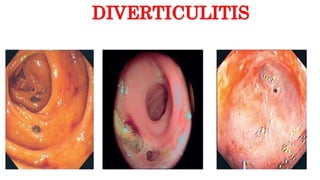 DIVERTICULITIS
 