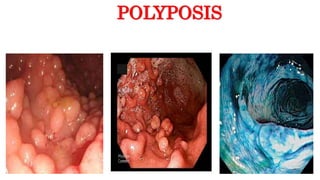 POLYPOSIS
 