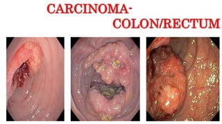 CARCINOMA-
COLON/RECTUM
 