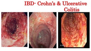 IBD- Crohn’s & Ulcerative
Colitis
 