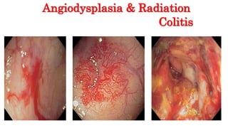 Angiodysplasia & Radiation
Colitis
 