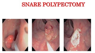 SNARE POLYPECTOMY
 