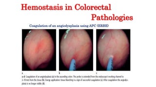 Hemostasis in Colorectal
Pathologies
Coagulation of an angiodysplasia using APC (ERBE)
 