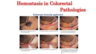 Hemostasis in Colorectal
Pathologies
Endoscopic hemoclip application
 