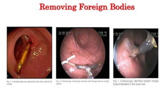 Removing Foreign Bodies
 