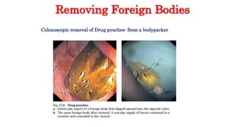Removing Foreign Bodies
Colonoscopic removal of Drug pouches- from a bodypacker
 