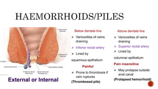 Below dentate line
 Varicosities of veins
draining
 Inferior rectal artery
 Lined by
squamous epithelium
Painful
 Prone to thrombosis if
vein ruptures
(Thrombosed pile)
Above dentate line
 Varicosities of veins
draining
 Superior rectal artery
 Lined by
columnar epithelium
Pain insensitive
 May prolapse outside
anal canal
(Prolapsed hemorrhoid)
 