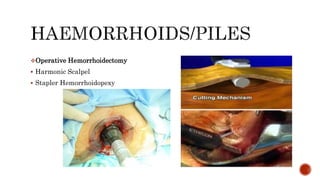 Operative Hemorrhoidectomy
 Harmonic Scalpel
 Stapler Hemorrhoidopexy
 